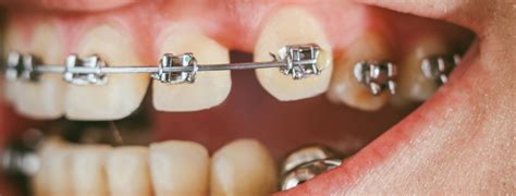 spacing between teeth - Dentist in Newbury Park