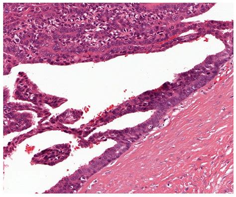 Tumors of the Epidermal Appendages | Plastic Surgery Key