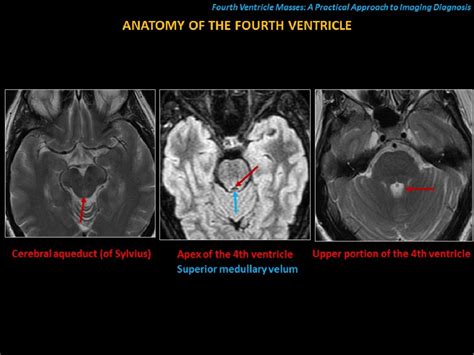 Fourth Ventricle Mri