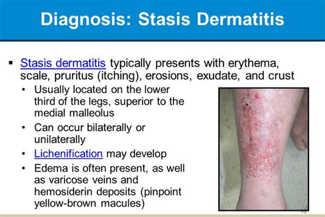 Stasis Dermatitis(Eczema on Legs) Symptoms Causes & Treatment