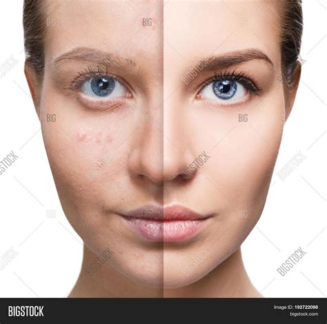 Woman Acne Before Image & Photo (Free Trial) | Bigstock