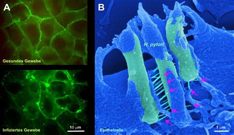 How Helicobacter pylori causes gastric cancer