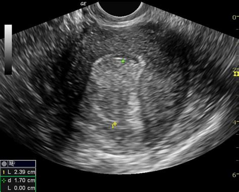 Uterine Polyps