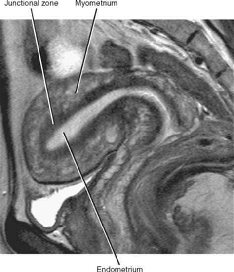 Uterus Anatomy Mri