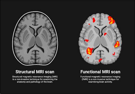 Structural vs Functional MRI Scan | BioRender Science Templates