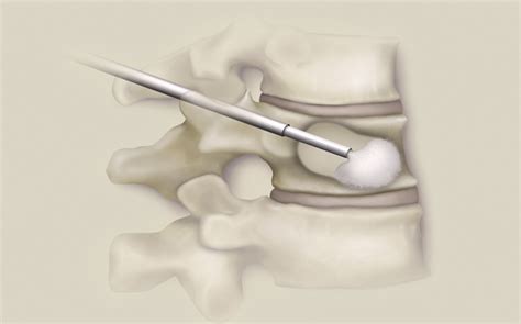 Medtronic Launches New Balloon Kyphoplasty Products for Treating Spinal ...