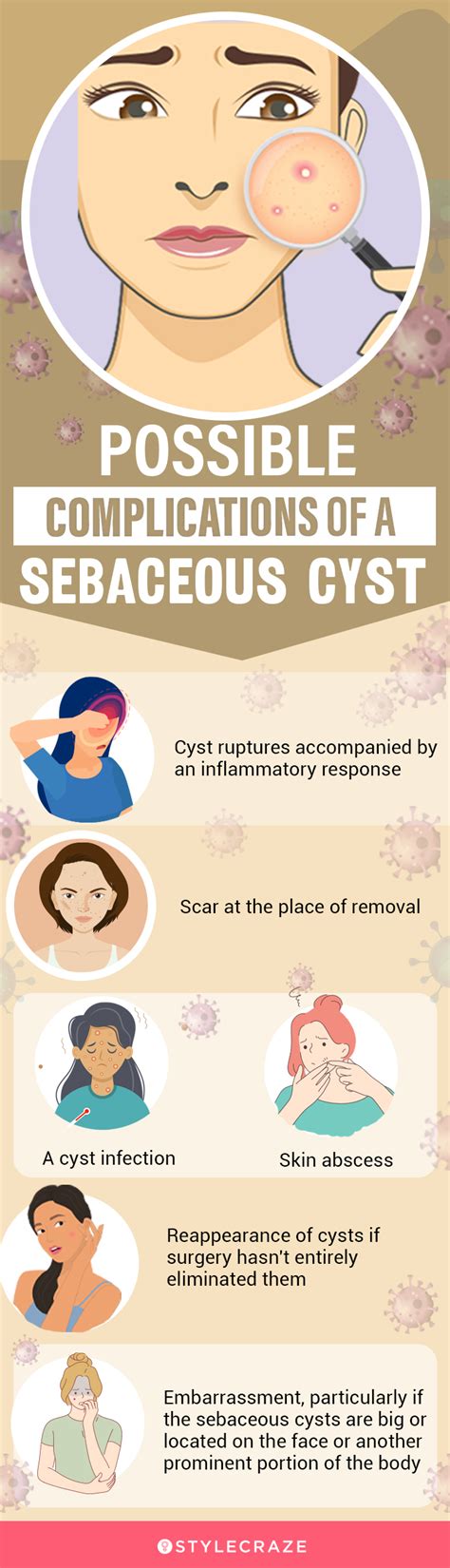 14 Home Remedies To Treat Sebaceous Cysts