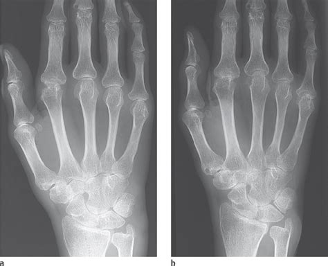 Rheumatoid Arthritis X Ray Foot