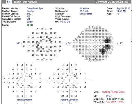 Getting Better Visual Field Results