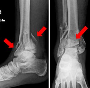 Pilon Fracture | Orthopaedic Trauma Association (OTA)