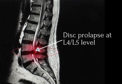 Disc Herniation Mri