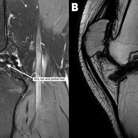 ACL showing lax and partial tear and PCL showing lax (A) ACL, MRI image ...