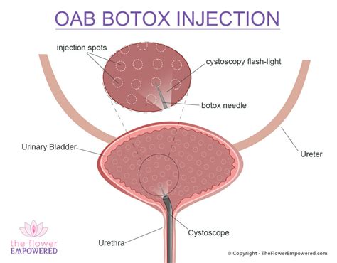 Overactive bladder (OAB) affects 17% of women with incontinence