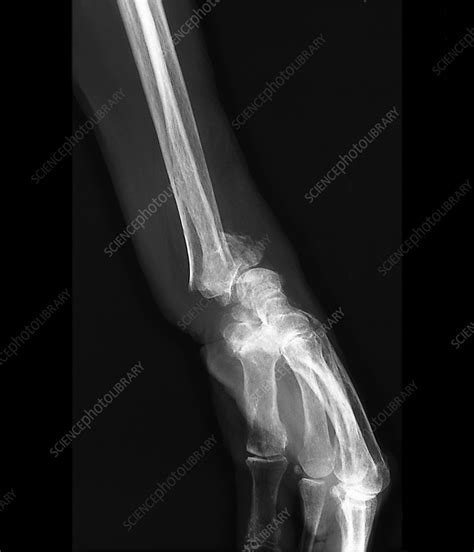 Wrist fracture, X-ray - Stock Image - C055/1182 - Science Photo Library