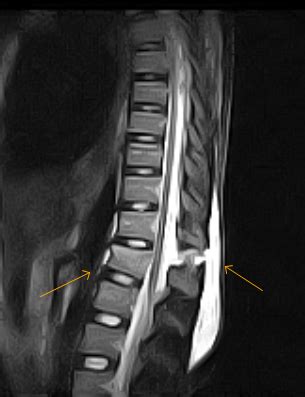 Posterior Ligamentous Injury - Sumer's Radiology Blog