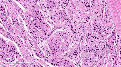 Pathology Outlines - Paraganglioma