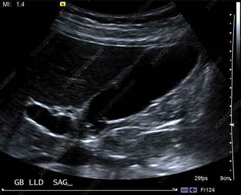 Normal gallbladder, ultrasound - Stock Image - C039/3192 - Science ...