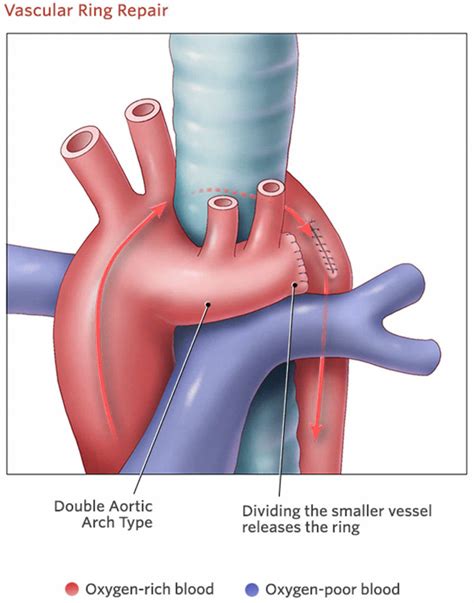 Double aortic arch causes, symptoms, diagnosis, treatment & prognosis