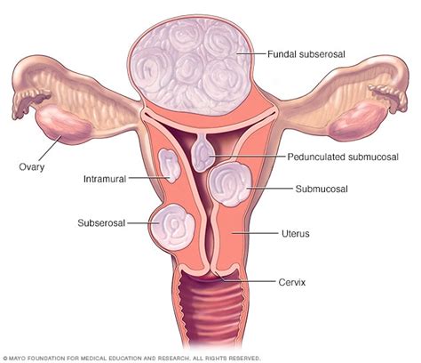 Fibroid locations - Mayo Clinic