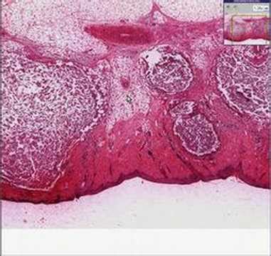 Histopathology Skin -- Furuncle (abscess) - YouTube