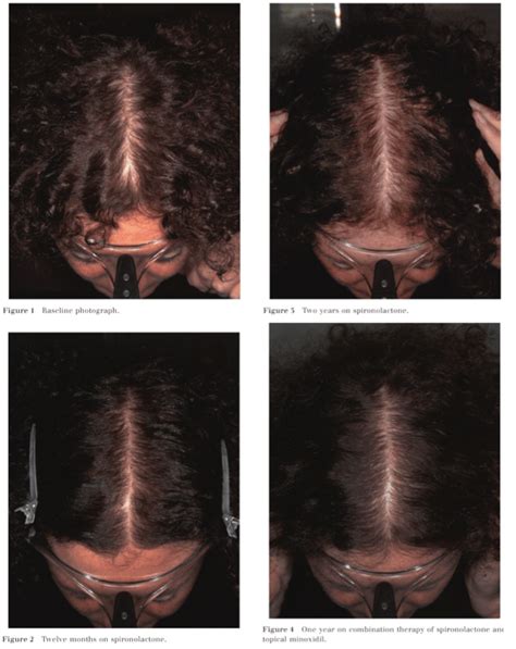 Spironolactone for Hair Growth: 2024 Guide - Hairguard