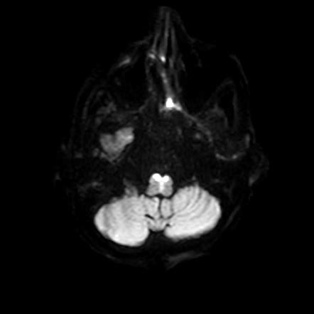 Heart sign (medulla) | Radiology Reference Article | Radiopaedia.org