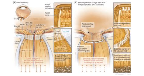 How Does Optic Nerve (Ganglion Cell) Damage Occur? | Glaucoma Australia