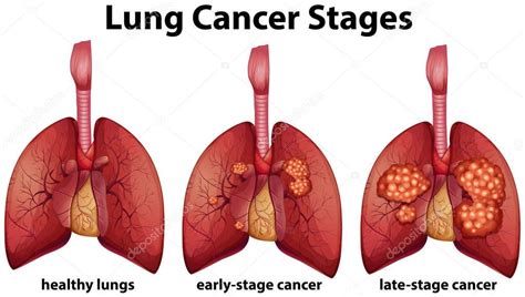 Tumor Size Chart For Lung Cancer