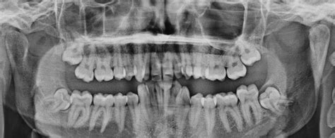 Wisdom Teeth - Hobart Orofacial Pain and Special Needs Clinic