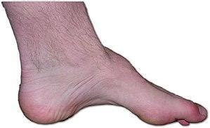 ORTHOTIC MANAGEMENT OF THE CAVOVARUS FOOT