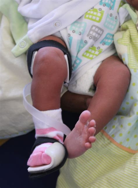 Clubfoot Bracing — Cunningham Prosthetic Care