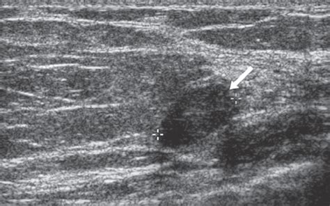 Focal Asymmetry | Radiology Key