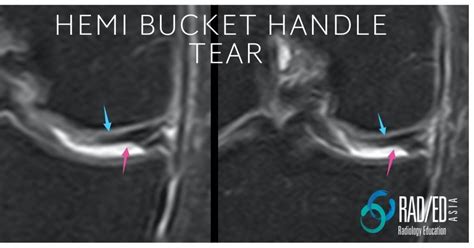 Hemi Bucket Handle Tear Knee MRI - Radedasia