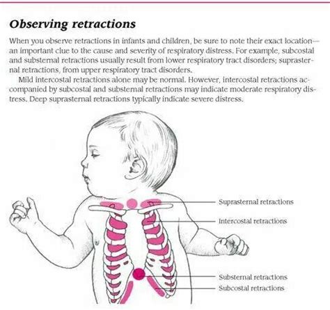 Retractions - Watch for this in babies. Newborn Nursing, Child Nursing, Nursing Students, Ob ...