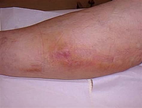 Thrombophlebitis Causes, Symptoms, Diagnosis and Treatment - Natural Health News