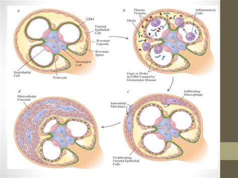 Kidney Disease Treatment and Diet: New Measures for the Treatment of RPGN