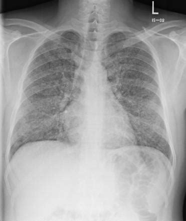 Pulmonary alveolar proteinosis | Radiology Reference Article ...