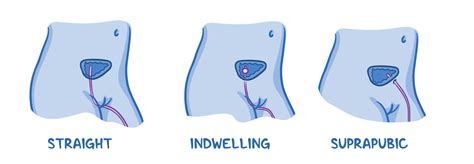 Urinary catheters and routine indwelling catheter care: Clinical skills notes | Osmosis