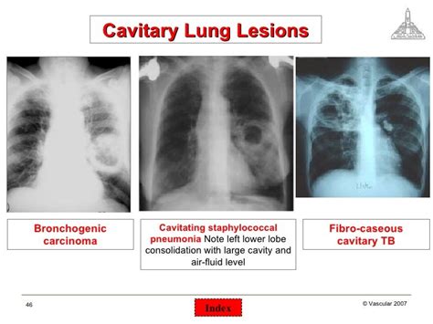 Chest surgical pathology &x rays