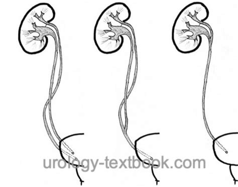 Duplex Kidney or Duplicated Ureter: Symptoms and Diagnosis