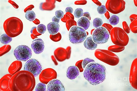 Acute Lymphoblastic Leukaemia Smear #3 Photograph by Science Photo ...