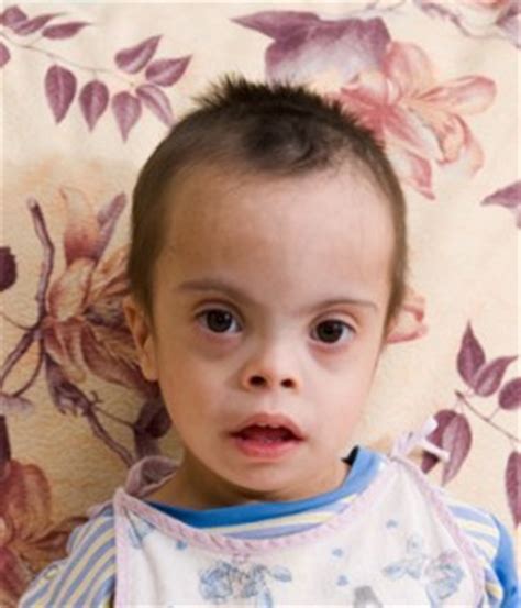 Trisomy 14 Syndrome