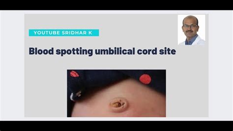 What to do if there is blood spotting at umbilical cord site? Dr Sridhar - YouTube