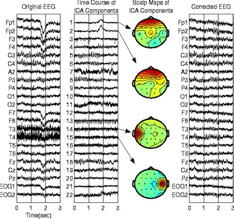 EEG artifact removal with Blind Source Separation