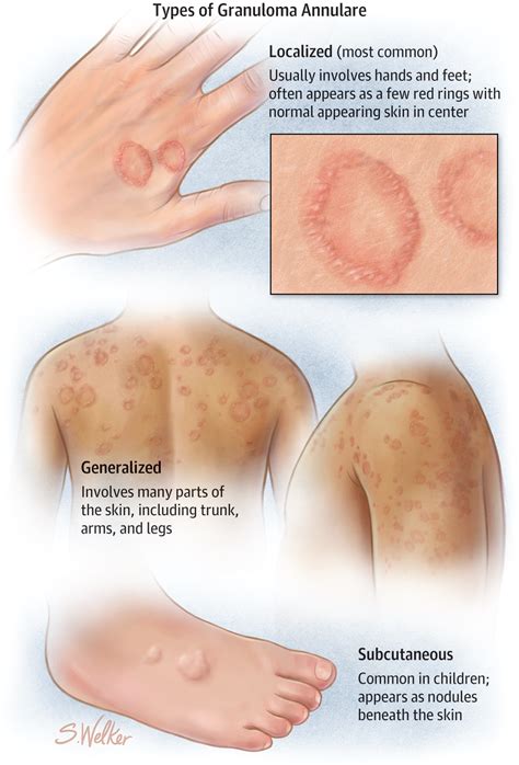 Granuloma Annulare | Granuloma annulare, Dermatology nurse, Medical knowledge