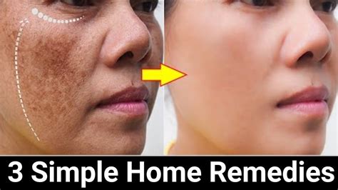 How I Remove Pigmentation Naturally And Permanently