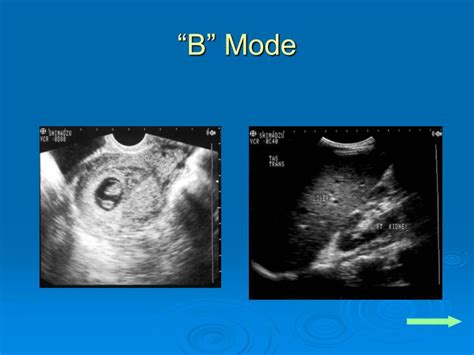 PPT - Ultrasound Physics PowerPoint Presentation - ID:1244413