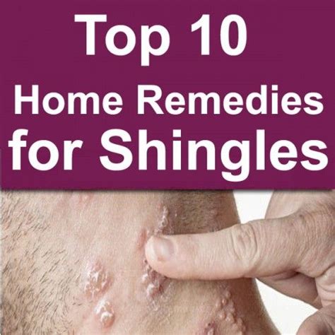 Top 10 Home Remedies for Shingles | Home remedies, Top 10 home remedies ...