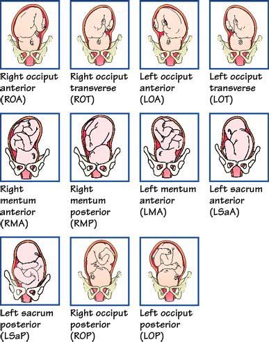 Image result for occiput transverse presentation | Nursing school ...