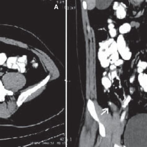 (A, B): Distal appendicitis. Contrast-enhanced axial CT scan (A) shows ...